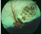 Photo of Retinal Prosthesis