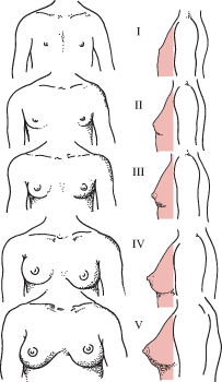 Diagrammatic representation of Tanner stages I to V of human breast maturation.