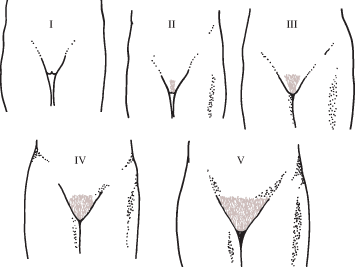 Diagrammatic representation of Tanner stages I to V for development of pubic hair in girls.