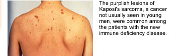 The purple lesions of Kaposi's sarcoma, an unusual kind of cancer to be seen in young men, were common among the cases of immune deficiency reported in 1981. 
