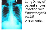 X-ray shows infection with Pneumocystis carinii (typed in italics) in an immune-deficient patient studied at NIH. 